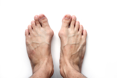 Bunion-Treatment-in-Normal-IL-Serving-Bloomington-and-Pontiac-IL